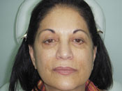 Liquid Facelift Before Pic