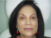 Liquid Facelift After Pic