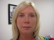 Liquid Facelift After Pic