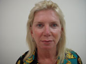 Liquid Facelift Before Pic